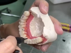 Prótese completa fixa de longa duração com ponte de coroa cerâmica de base de titânio para restauração dental
