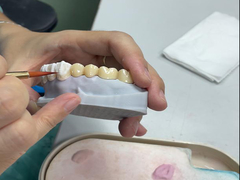 Coroas de cerâmica translúcida para restauração dental com estética natural e fácil limpeza