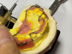 Aplicativo de ortodoncia feito sob medida com boa retenção e características ajustáveis