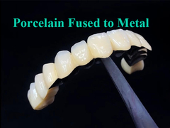 Porcelana fundida com coroa de metal que combina durabilidade e beleza para a saúde dentária