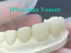EMAX Veneer A solução ideal para restaurações dentárias duradouras e estéticas