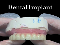 Os implantes dentários são a solução ideal para substituir os dentes perdidos e restaurar o sorriso