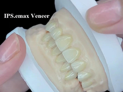 IPS.emax Veneer Premium Solução Estética Para Transformações de Sorriso Impressionantes