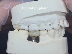 Implante Dental Ponte da Coroa