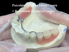 Porcelana fundida com coroa de metal e dentaduras removíveis