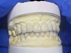 Veneers de porcelana IPS EMAX para restaurações de dentes frontais de aparência natural