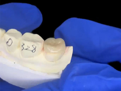 IPS de aparência natural e durável e.max Inlays de cerâmica Onlays mistura sem costura com os dentes