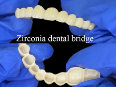Ponte Dental de Zirconia Restauração de aparência forte e natural para um sorriso perfeito