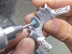 Dentadura parcial fundida