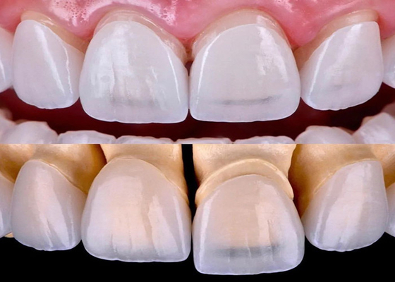 comprar Finete dentário EMAX de longa duração fabricado com material cerâmico de zircônio online manufacture