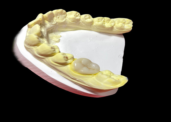comprar Inlays e Onlays Cerâmicos de Alta Qualidade para Restauração Dentária Sem Secções e de Longa Duração online manufacture