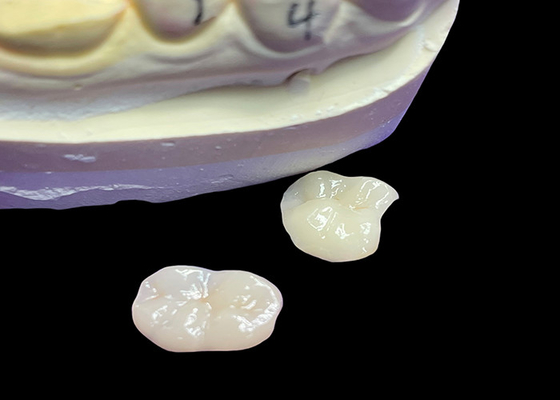 comprar IPS e.max Inlays e Onlays cerâmicos para restauração molar Estética natural e durabilidade superior para resultados duradouros online manufacture