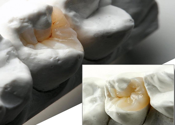 comprar Inlays e Onlays de cerâmica de aparência natural para restauração dental precisa do nosso laboratório dental especializado online manufacture