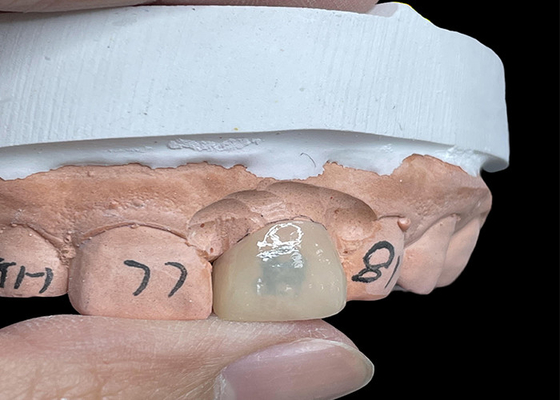comprar Os folheados EMAX transformam seu sorriso com dentes de aparência natural altamente translúcidos online manufacture