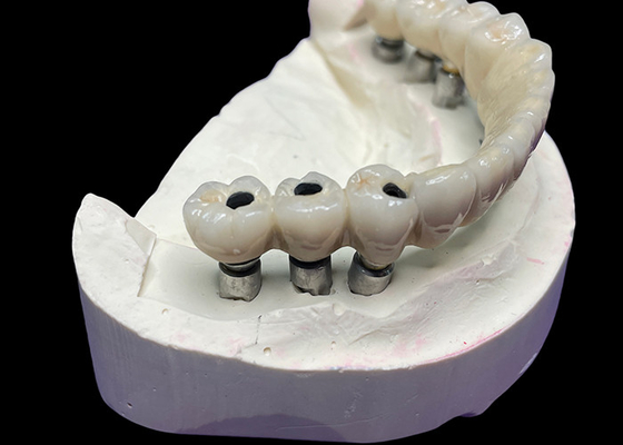 comprar O implante dentário com uma base de titânio é coberto com uma bela ponte de coroa de cerâmica para criar uma restauração perfeita. online manufacture