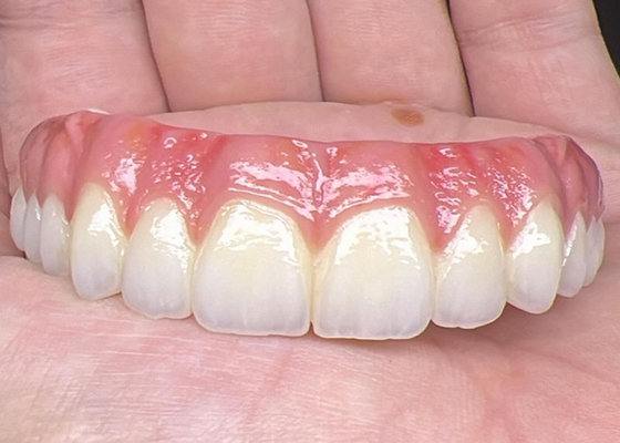 comprar Saúde Oral Implante Dental Dentes dentários apoiados Ponte Superfície polida Suporte Dentes dentários completos online manufacture