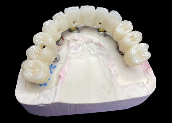 comprar Coroas e pontes de implantes dentários de arco completo Restauração de função e estética com soluções avançadas online manufacture