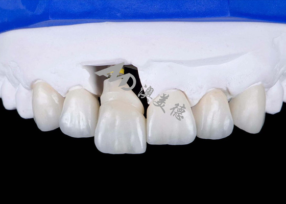 comprar Coroa de implantes dentários com abutment de titânio para sorrisos de aparência natural online manufacture