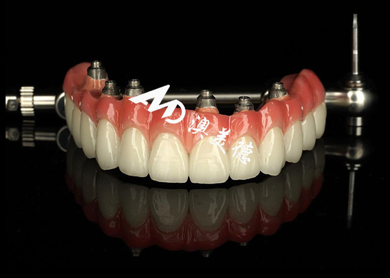 comprar Implante dentário personalizado dentaduras dentárias suportadas Crown Bridge Para manutenção de dentes ausentes online manufacture