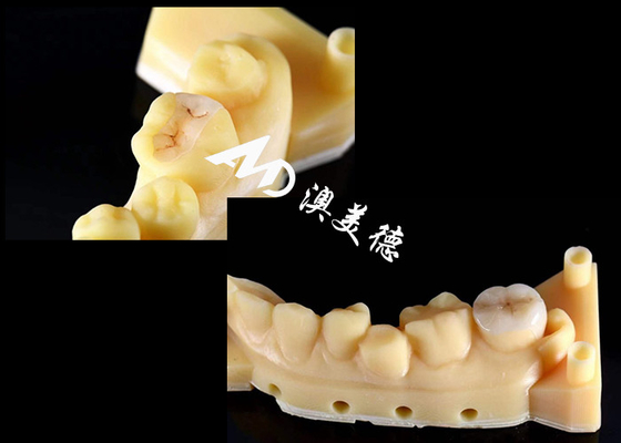 comprar Inlays cerâmicos de precisão e onlays para reparação de dentes com cor natural material hipoalergênico e adequado sem costura para conforto superior e durabilidade online manufacture