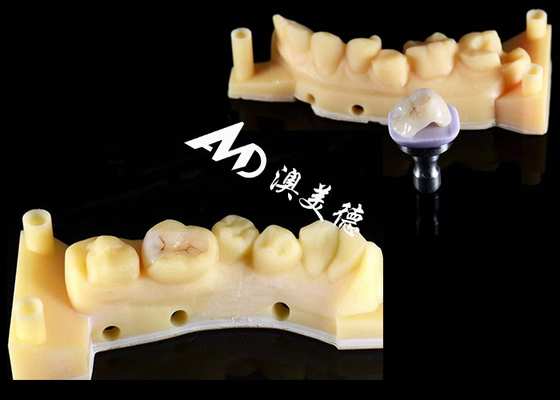 comprar Inlays de cerâmica suave hipoalergênico Onlays personalizado resistência à mancha alta durabilidade online manufacture