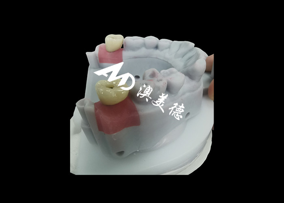 comprar Coroa de implante dentário com pilar de titânio para restauração dental durável online manufacture
