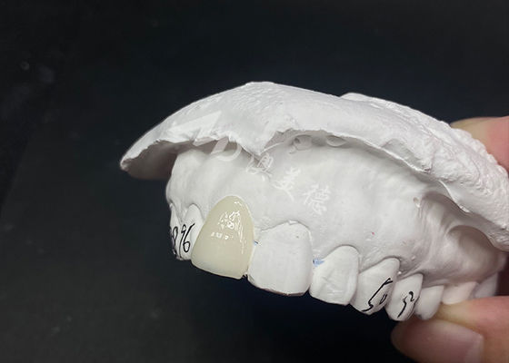 Bom preço Finetes Dentários Translúcidos Personalizados Soluções Rápidas e Eficazes para um Sorriso Duradouro on-line