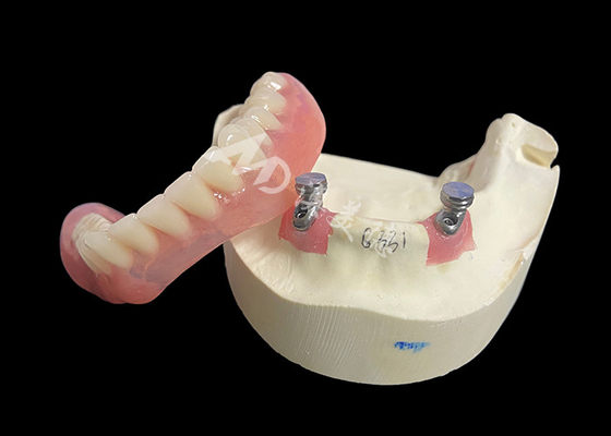 comprar Solução de sobredentura de barra de localizador de implantes para melhor mastigação e fala online manufacture