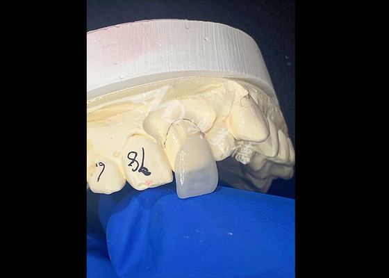 comprar IPS e.max Veneers para incisores na tonalidade A1 Estética natural para sorrisos perfeitos online manufacture