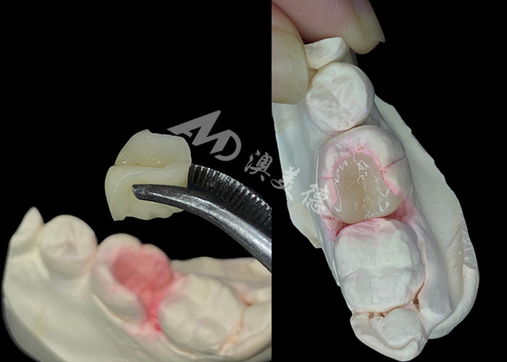 comprar IPS e.max Inlays e Onlays cerâmicos para restauração dental de aparência natural online manufacture
