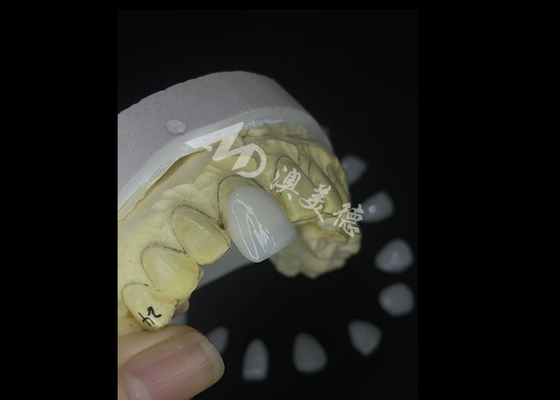 comprar Veneers IPS e.max de fabricação de precisão para transformações inigualáveis do sorriso que oferecem uma estética de durabilidade excepcional online manufacture