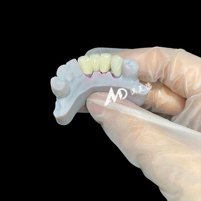 comprar Coroa dental de zircônio com núcleo de poste de metal oferecendo uma estética de aparência natural Adaptação precisa e biocompatibilidade superior online manufacture