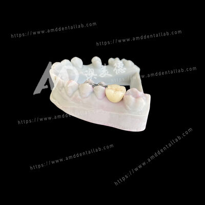 comprar PFM Ponte de Maryland com um Pôntico e Duas Asas: Uma Solução Conservadora e Estética online manufacture