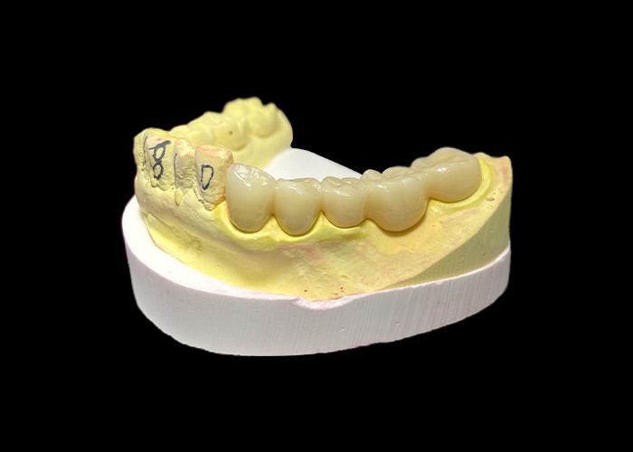 Coroa dental de porcelana de zircônio de qualidade superior Força inigualável Precisão de ajuste e estética e durabilidade excepcionais