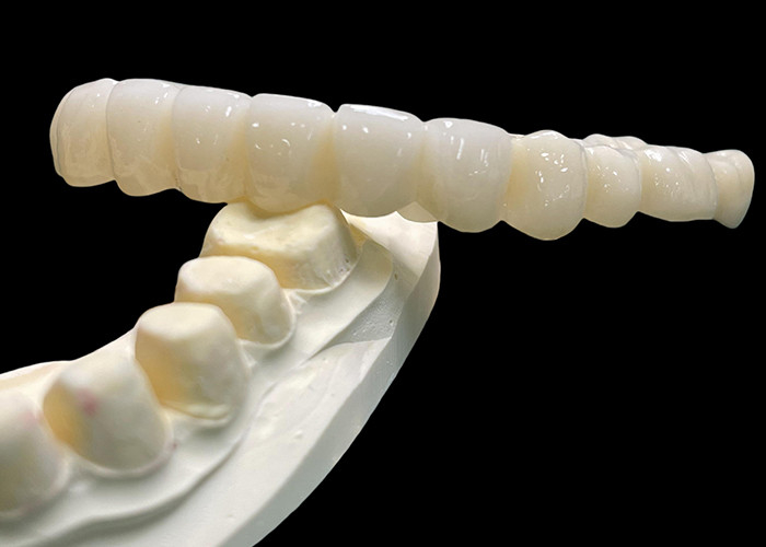 Vita Classical Shade All Ceramic Crown Bridge Natural Procurando Restauração Dental