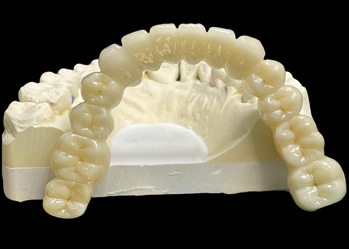 Vita Classical Shade All Ceramic Crown Bridge Natural Procurando Restauração Dental