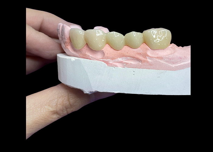 Todas as coroas e pontes de cerâmica projetadas para uma estética superior, durabilidade e ajuste natural para uma confiança duradoura.
