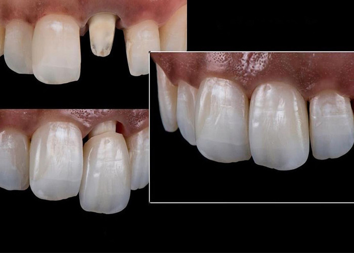 Todas as coroas e pontes de cerâmica projetadas para uma estética superior, durabilidade e ajuste natural para uma confiança duradoura.