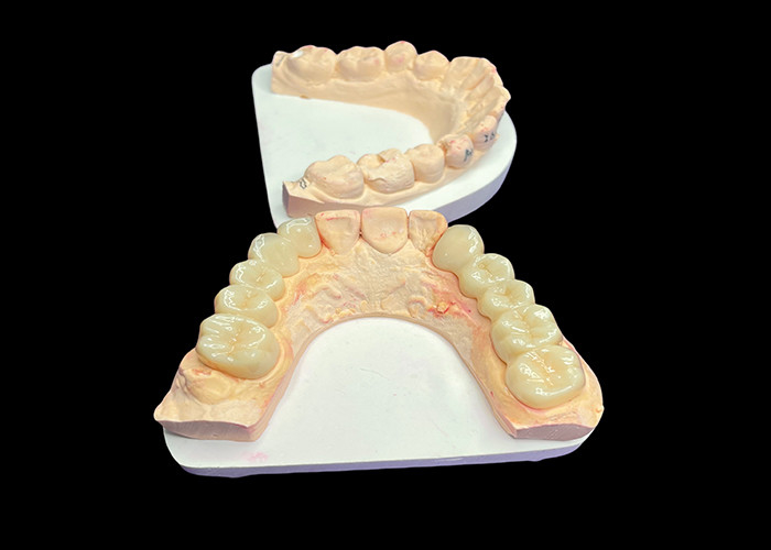 Estética natural Coroas de cerâmica translúcidas para restauração dentária com limpeza fácil e resultados duradouros