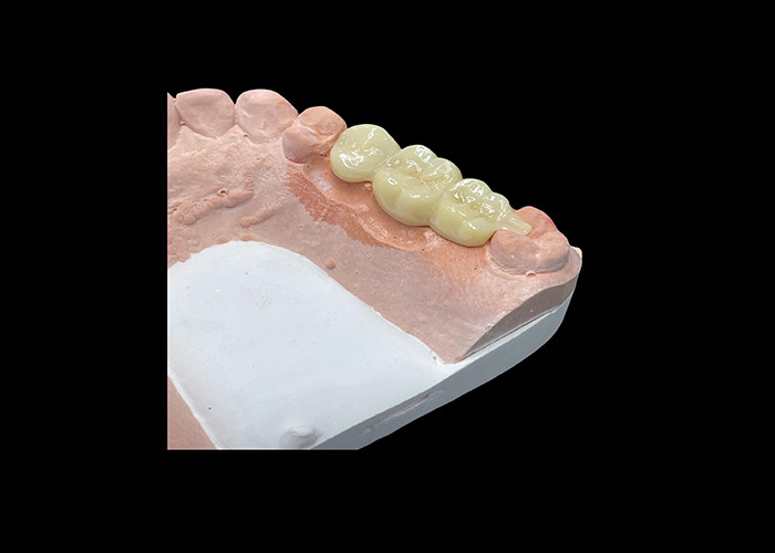 Estética natural Coroas de cerâmica translúcidas para restauração dentária com limpeza fácil e resultados duradouros