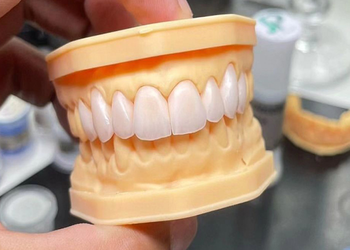 Ponte de coroa de cerâmica de alta resistência com biocompatibilidade excepcional para durabilidade duradoura
