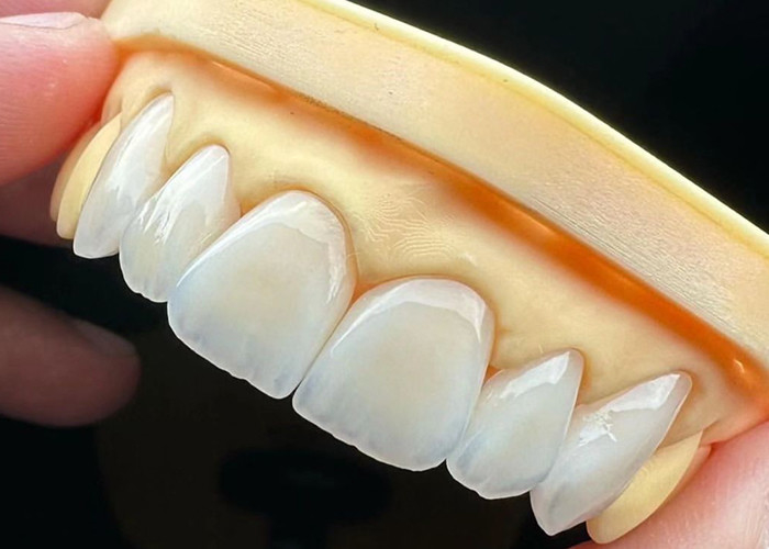 Ponte de coroa de cerâmica de alta resistência com biocompatibilidade excepcional para durabilidade duradoura