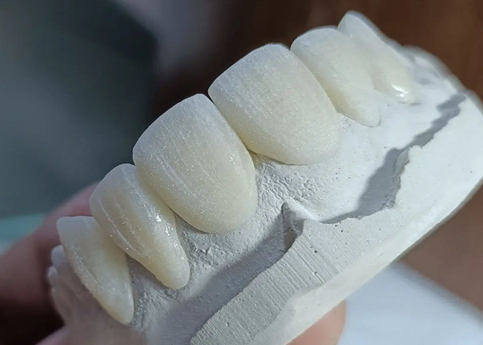 Ponte de coroa de cerâmica resistente ao desgaste para restauração dental confortável e precisa
