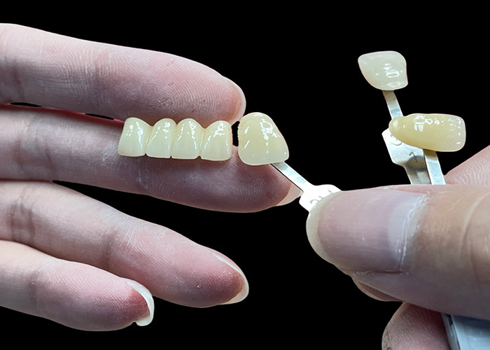 Resistente a manchas Todas as pontes de porcelana confortável adequado para restauração dentária