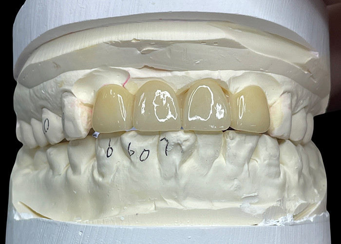 Resistente a manchas Todas as pontes de porcelana confortável adequado para restauração dentária