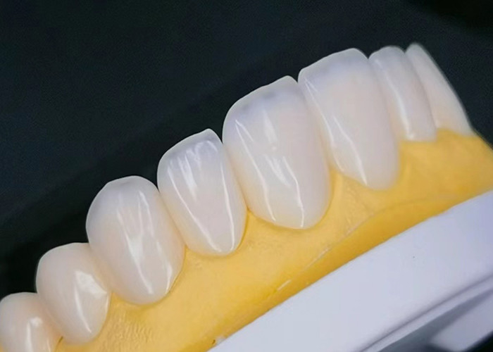 Veneer de porcelana EMAX com resistência a manchas para restaurações estéticas de aparência natural