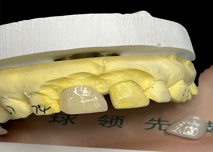 Veneer de porcelana EMAX com resistência a manchas para restaurações estéticas de aparência natural
