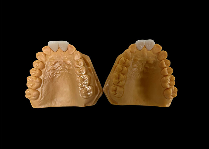 Coroa dental de zircônia estética personalizada perfeitamente adaptada para dentes anteriores e posteriores
