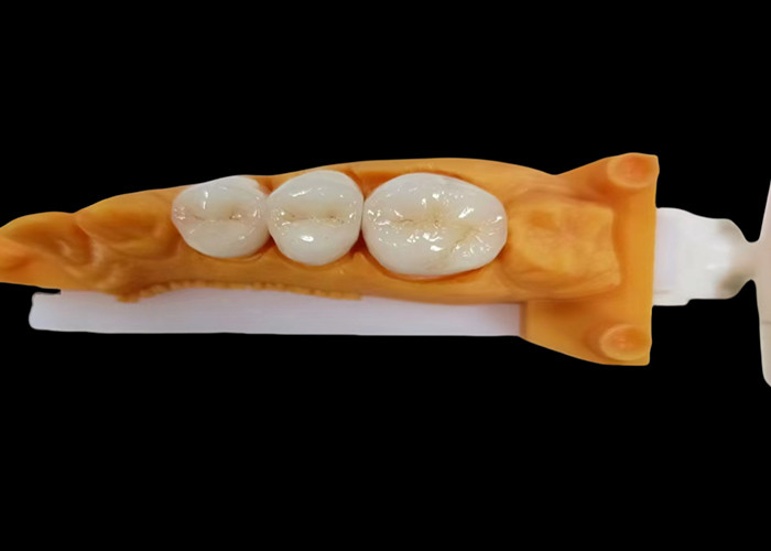 Coroa dental de zircônio resistente ao desgaste com resistência a escoriações e manchas e estética natural do laboratório dentário da China