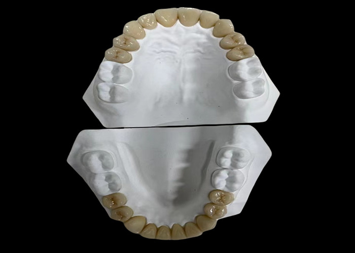 Confortável ponte dental de porcelana com construção totalmente cerâmica para resistência excepcional ao desgaste